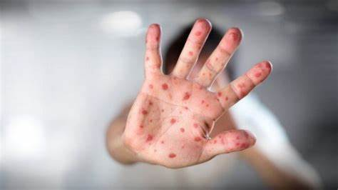 How To Prevent And Treat Monkeypox