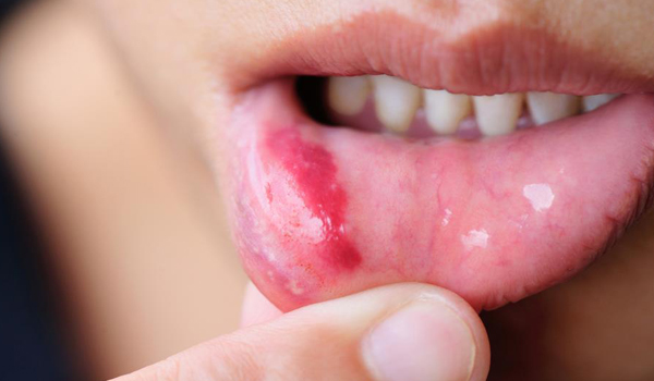 how to treat troubling mouth problems